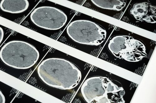 Burbank brain injury lawyer